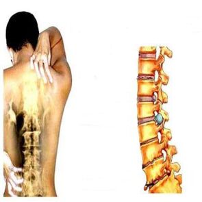 Stages of osteochondrosis