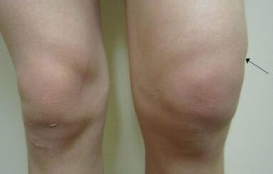 Clinical manifestations of knee arthrosis