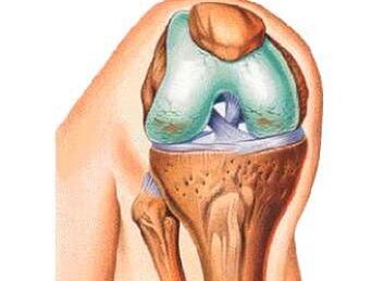The underlying causes of knee arthrosis