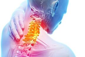 Symptoms of Cervical Osteochondrosis and Disease Nutrition Rules