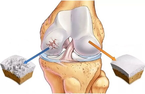 Healthy cartilage and cartilage with arthrosis