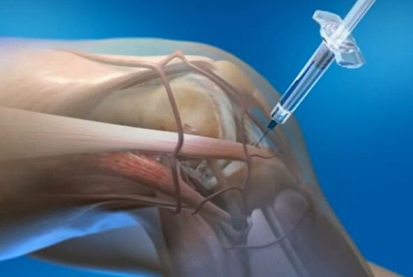 Intra -sorcular injections for knee joint arthrosis