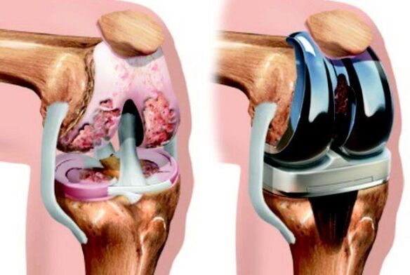 Knee joint endoprosthesis before and after arthrosis