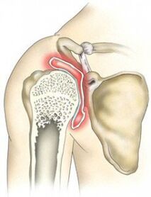 Destruction of the shoulder joint due to arthrosis
