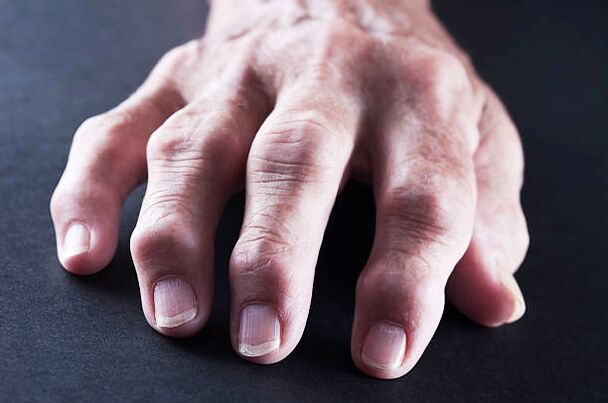 Pain in finger joints