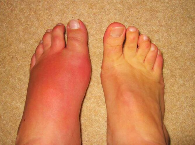 Pain in the joints of the feet due to gout