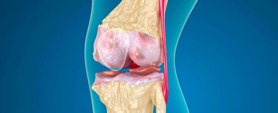 Arthrosis of the knee joint